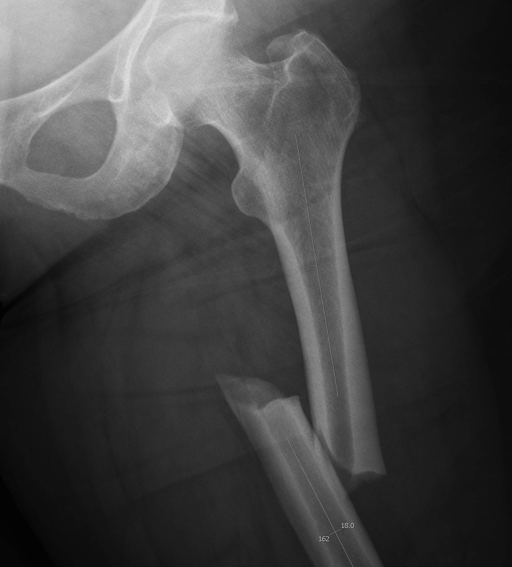 Bisphosphonate Femoral Fracture